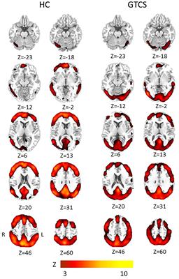 Altered Local Spatiotemporal Consistency of Resting-State BOLD Signals in Patients with <mark class="highlighted">Generalized Tonic-Clonic Seizures</mark>